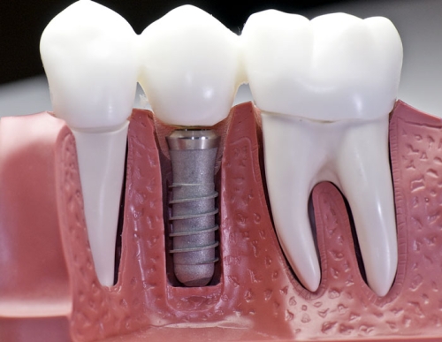 Implant giải pháp tối ưu cho người mất răng
